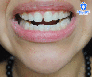 Sau khi tháo niềng, răng vẫn chưa được ổn định nền cần phải duy trì để đảm bảo tính ổn định cho răng khỏi bị xô lệch lại.