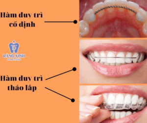 Phương pháp bắt buộc để duy trì kết quả niềng răng đạt hiệu quả tốt là đeo hàm duy trì sau khi niềng răng.
