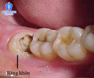 Răng khôn- chiếc răng gây nhiều phiền toái, ảnh hưởng đến cuộc sống hàng ngày.