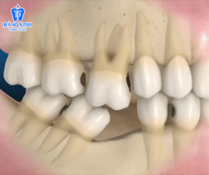 Mất răng lâu ngày gây nên tình trạng tiêu xương hàm, làm xô lệch cấc răng bên cạnh , ảnh hưởng đến việc ăn nhai và tính thẩm mỹ cho khuôn mặt.