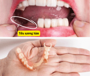 Tiêu xương hàm do đeo hàm răng giả lâu năm..