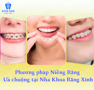 Nhiều phương pháp niềng răng đều được áp dụng chương trình ưu đãi trong mùa hè này.