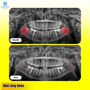 Việc nhổ răng khôn bằng công nghệ mới không gây tổn thương mô mềm...