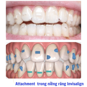 Attachment có vai trò quan trọng, cơ chế tạo điểm bám cho khay Invisalign, giúp tăng lực kéo và hướng di chuyển của răng.