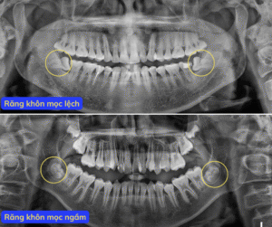 Răng khôn mọc lệch, mọc ngầm cần xử lý sớm để tránh biến chứng gây sưng gây đau..