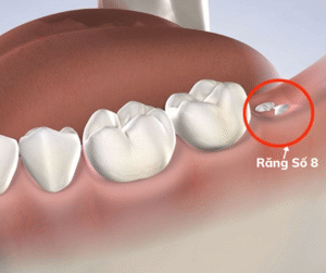 Răng khôn hay còn gọi là răng số 8 nằm phía trong cùng ở mỗi góc hàm.