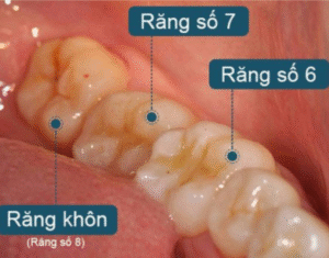 Răng khôn mọc ở vị trí cuối của cung hàm trong độ tuổi từ 18-25