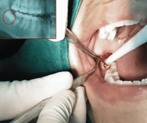 Đâu là thời điểm thích hợp để nhổ răng khôn