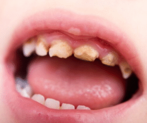 Nhiều người cứ nghĩ cao răng chỉ xuất hiện ở người lớn, nhưng thực tế ở trẻ em cao răng cũng rất phổ biến.
