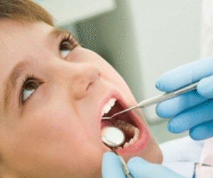 Lấy cao răng ở trẻ có thật sự cần thiết?