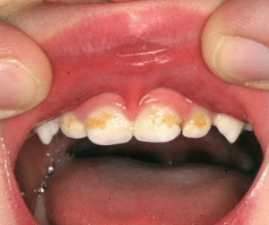 Những quan điểm sai lầm từ phụ huynh có thể ảnh hưởng đến sức khỏe răng miệng của trẻ về lâu về dài...