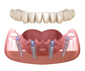Đối với trồng răng Implant toàn hàm thì thời gian sẽ lâu hơn.