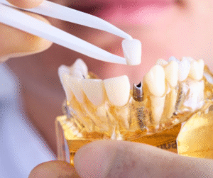 Thông thường thời gian cấy trụ implant mất khoảng 30 – 60 phút, sau đó bệnh nhân sẽ đợi từ 3 – 6 tháng để hoàn tất quá trình trồng răng Implant.