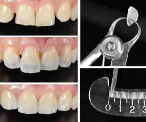 Dán sứ veneer là phương pháp phục hình thẩm mỹ răng, mặt sứ siêu mỏng từ 0.2 – 0.5 mm...