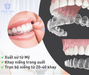 Trung bình một bộ niềng Invisalign thường sử dụng từ 20 đến 40 khay niềng trong suốt.
