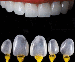 Dán sứ Veneer.