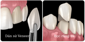 Dán sứ veneer hạn chế mài răng bảo tồn răng gốc tối đa so với bọc sứ.