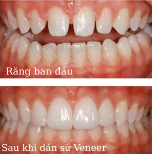Dán sứ mang đến tính thẩm mỹ cực cao.