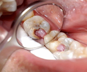 Sâu răng thời gian dài không được điều trị sẽ làm lung lay chân răng dẫn đến mất răng..