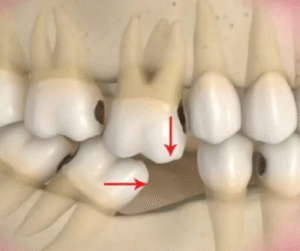 Tiêu xương do mất răng răng lâu năm có thể làm lung lay răng còn lại trên cung hàm..