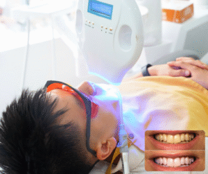 Tẩy trăng răng có làm hỏng men răng không??