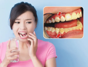 Việc tự ý tẩy trắng răng bằng những sản phẩm trôi nổi không rõ nguồn gốc, không đúng kỷ thuật sẽ gây tôn hại men răng thậm chí là hỏng men răng..