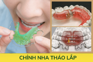 Chỉnh nha tháo lắp