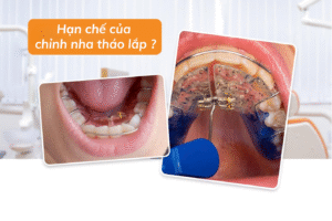 Nhược điểm đầu tiên của hàm giả tháo lắp đó chính là khả năng nhai còn hạn chế...