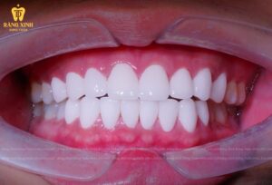Răng sứ tại Nha Khoa Răng Xinh Dung Tuấn