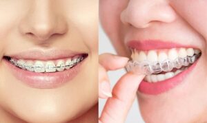 Invisalign hay mắc cài – đâu là lựa chọn phù hợp cho bạn?