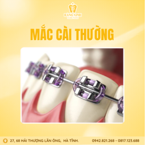 Mắc cài thường