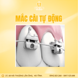 Mắc cài tự động