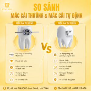 So Sánh Mắc Cài Thường Và Mắc Cài Tự Buộc