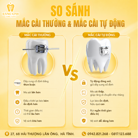 So Sánh Mắc Cài Thường Và Mắc Cài Tự Buộc