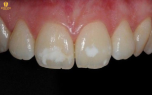 Răng có thể xuất hiện các đốm trắng đục như phấn